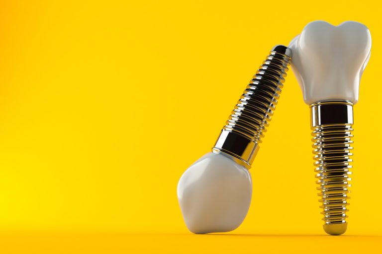 What To Know About Dental Implants In Miami